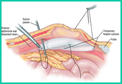 Laparoscopic Hernia repair