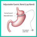 Gastric Banding