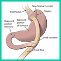 Gastric Bypass