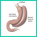 Sleeve Gastrectomy