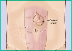 Ventral Hernia - Types of hernia
