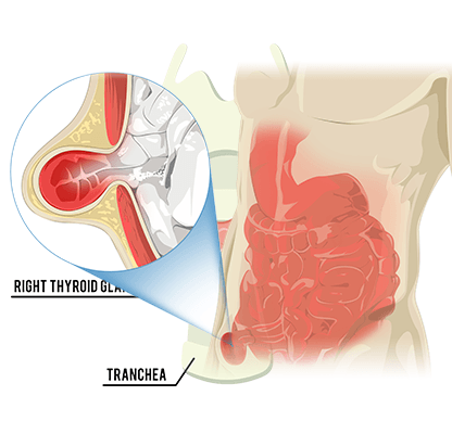 hernia_banner