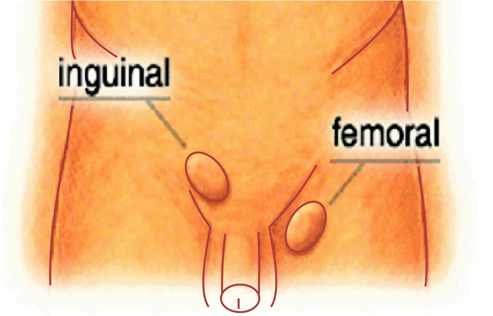hernia
