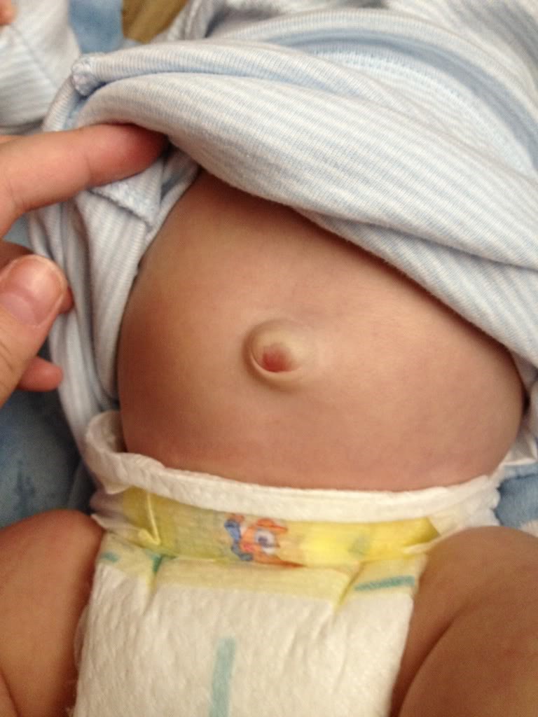 hernia