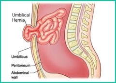 hernia