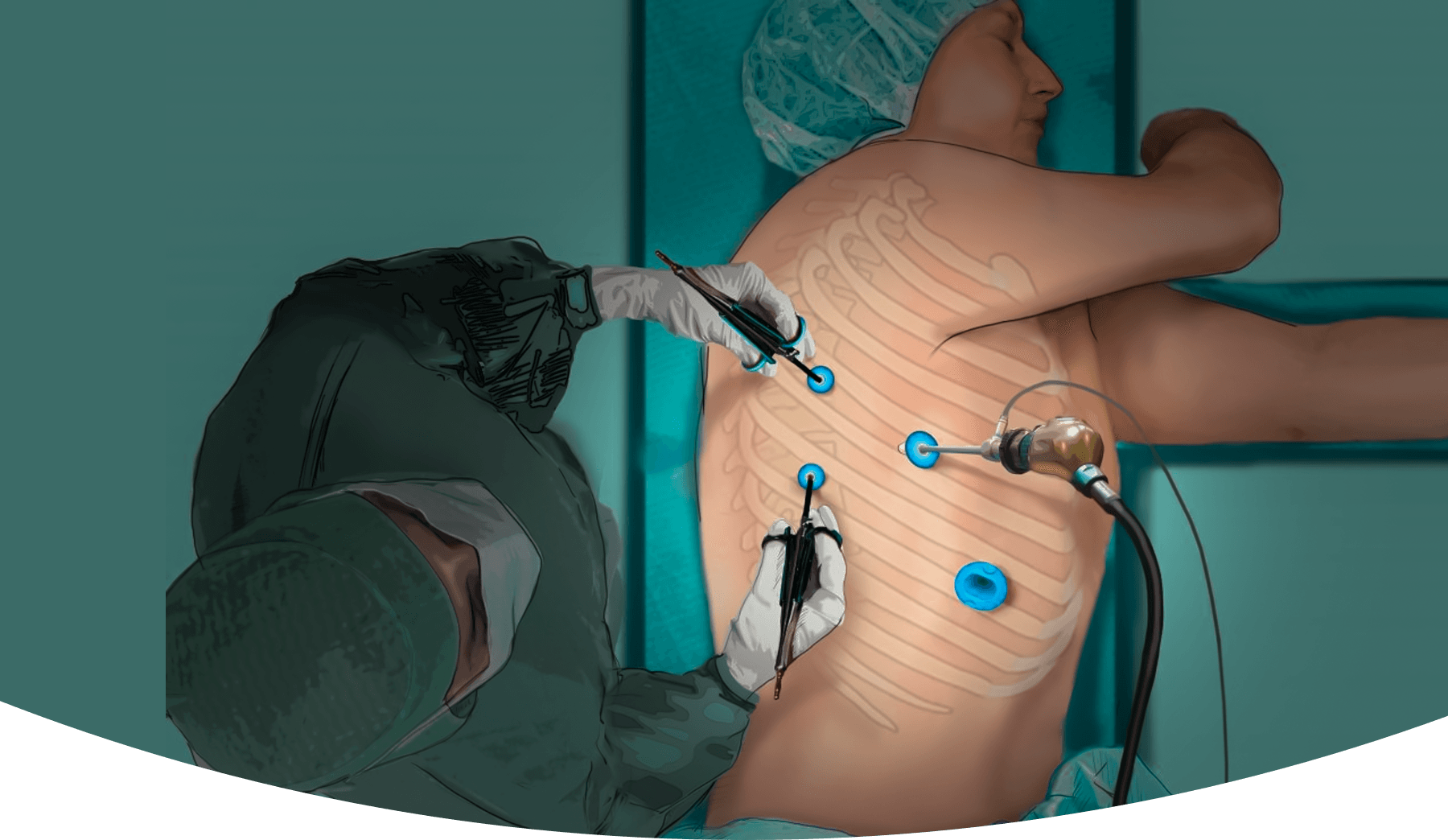 Thoracoscopic surgery