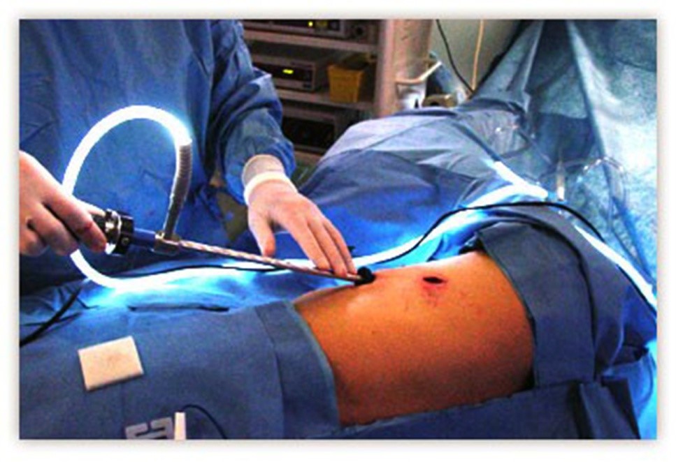 Thoracoscopic surgery