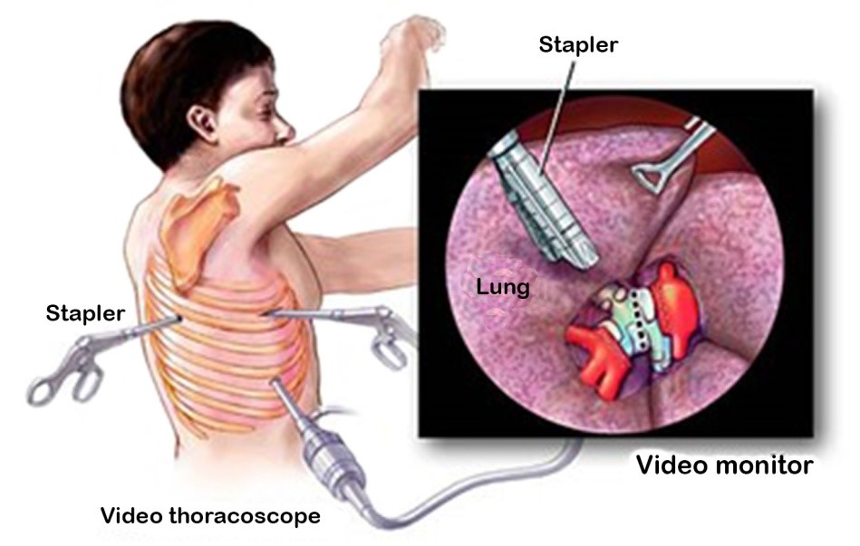 Thoracoscopic surgery