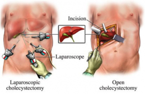 Difference in Laparoscopic Appendix Surgery and Open Surgery