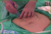 Laparoscopic incisional hernia